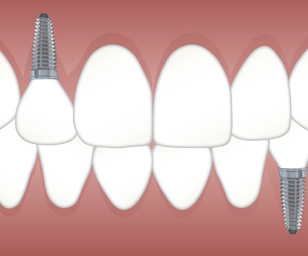 Czym jest implant zębowy?